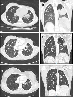 Frontiers | Clinical, Genetic, And Prognostic Features Of ...